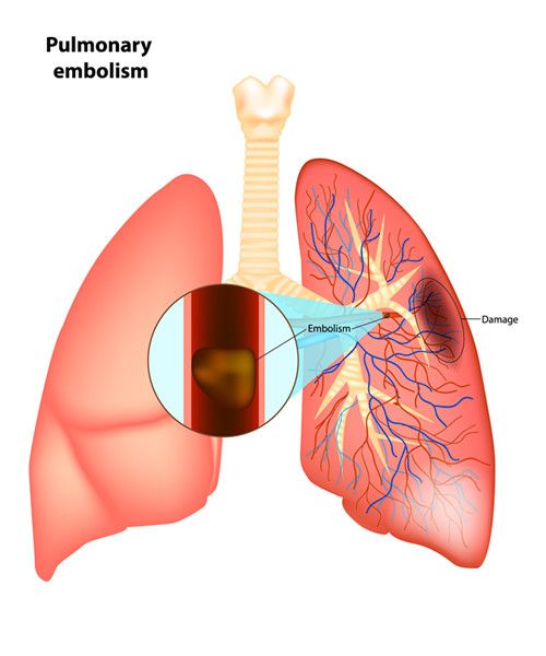 pulmonary embolism