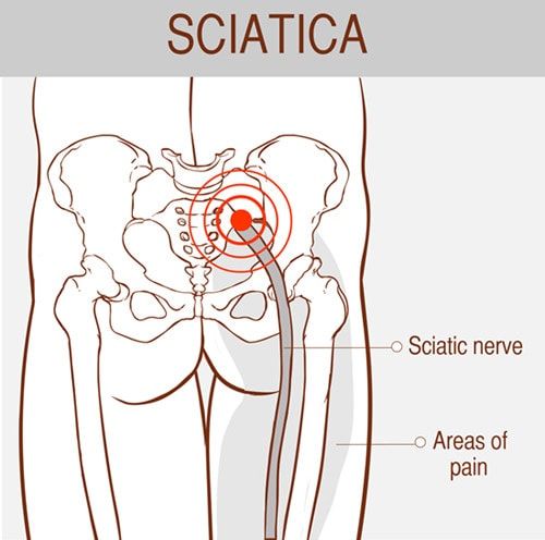 sciatica 